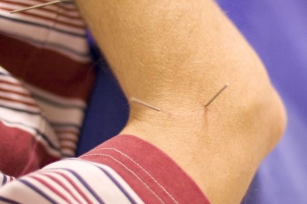 acupuncture-treatment (1)